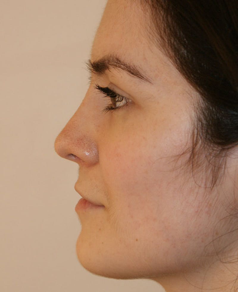 Rhinoplasty Before & After Gallery - Patient 251863 - Image 2