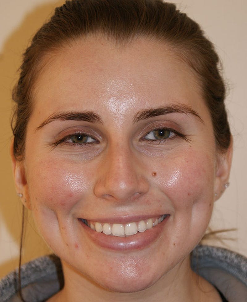 Rhinoplasty Before & After Gallery - Patient 128104 - Image 5