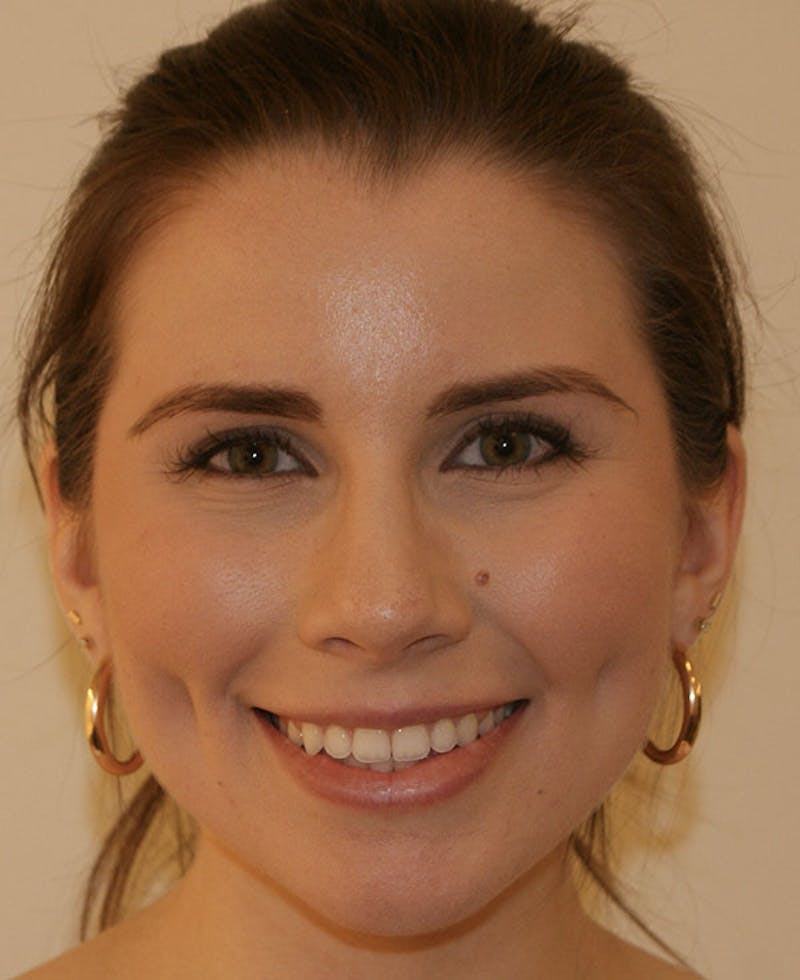 Rhinoplasty Before & After Gallery - Patient 128104 - Image 6