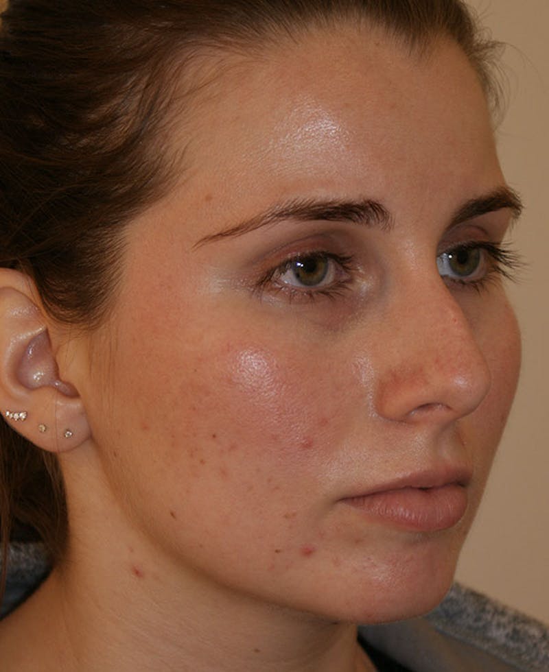 Rhinoplasty Before & After Gallery - Patient 128104 - Image 3