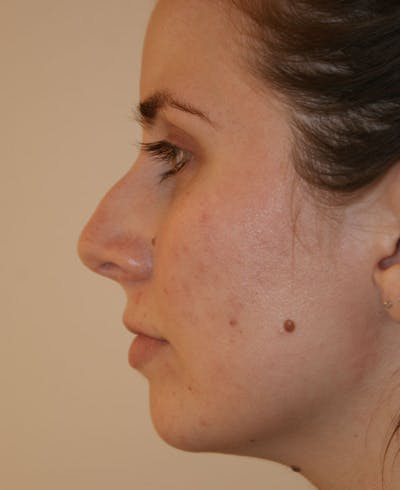 Rhinoplasty Before & After Gallery - Patient 128104 - Image 1