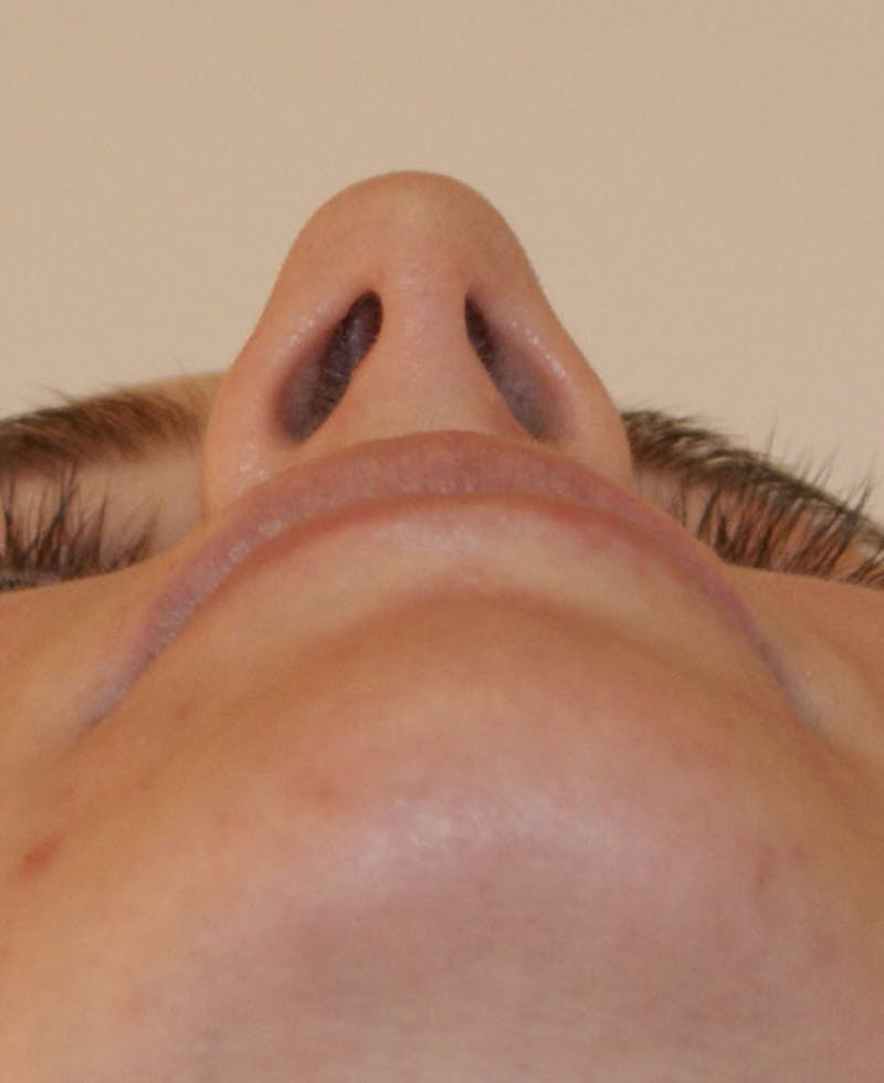 Rhinoplasty Before & After Gallery - Patient 128104 - Image 7
