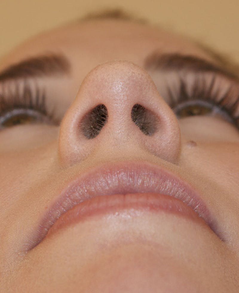 Rhinoplasty Before & After Gallery - Patient 128104 - Image 8
