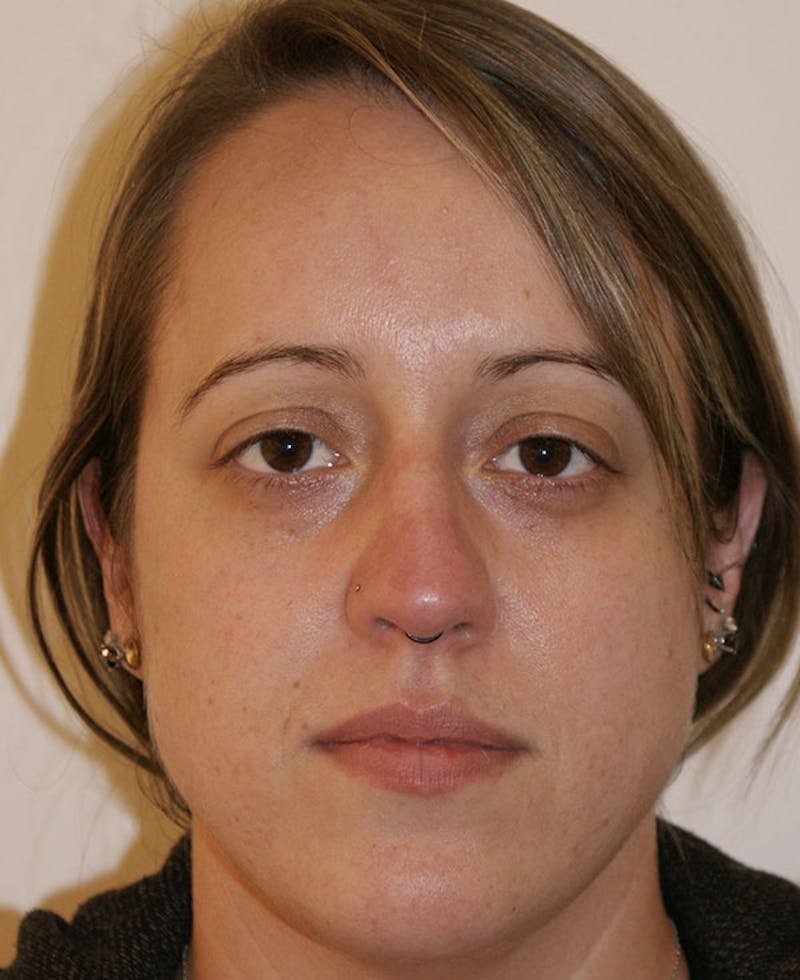 Rhinoplasty Before & After Gallery - Patient 145615 - Image 5