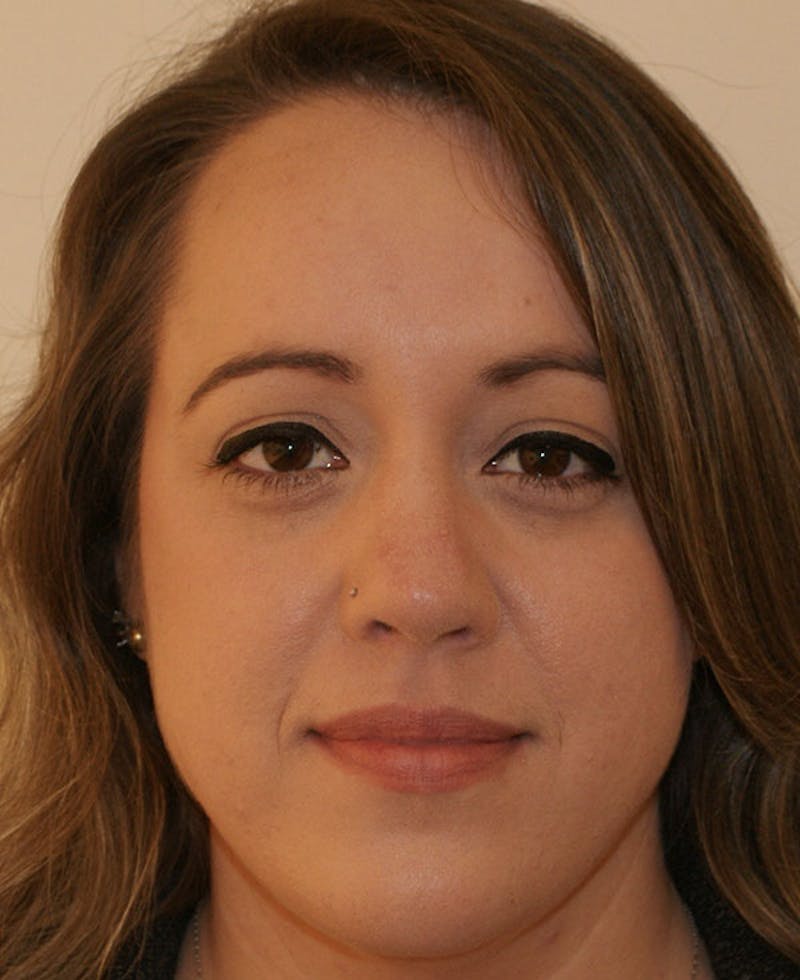Rhinoplasty Before & After Gallery - Patient 145615 - Image 6