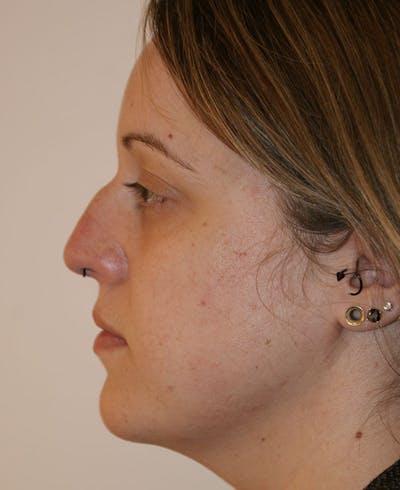 Rhinoplasty Before & After Gallery - Patient 145615 - Image 1