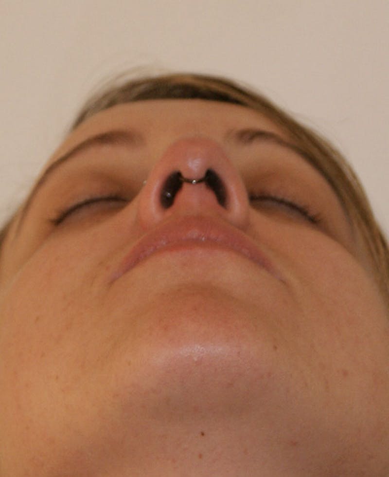 Rhinoplasty Before & After Gallery - Patient 145615 - Image 7