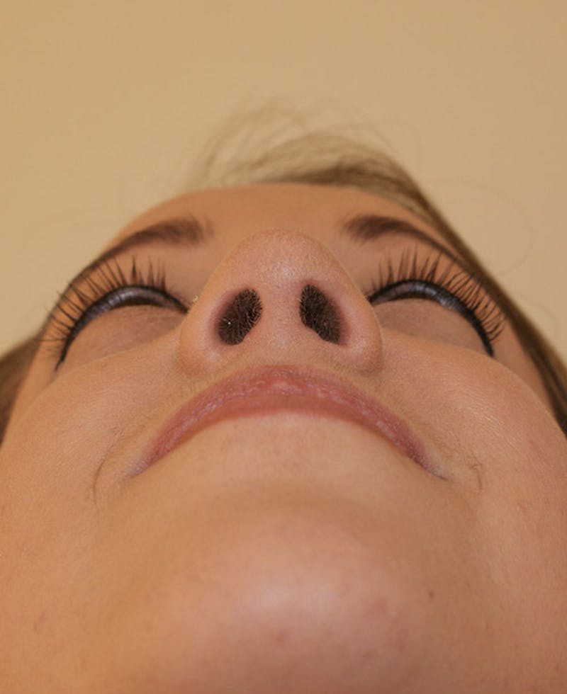Rhinoplasty Before & After Gallery - Patient 145615 - Image 8