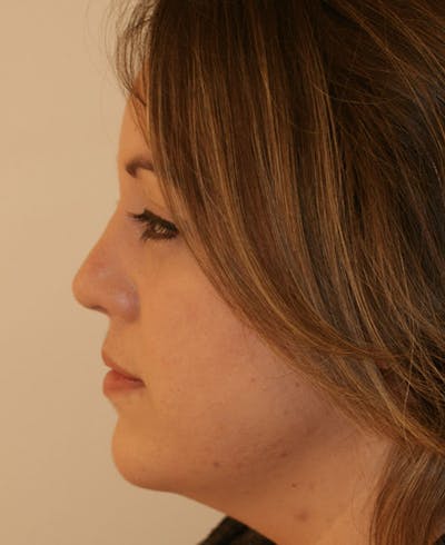 Rhinoplasty Before & After Gallery - Patient 145615 - Image 2