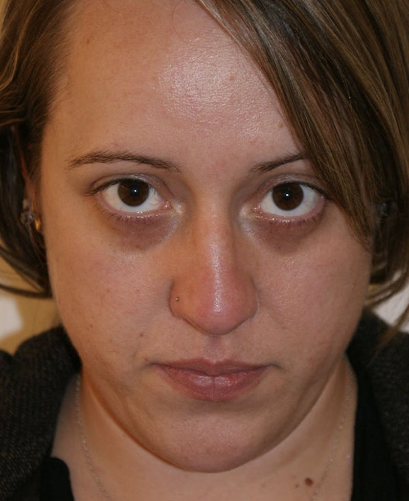 Rhinoplasty Before & After Gallery - Patient 145615 - Image 9