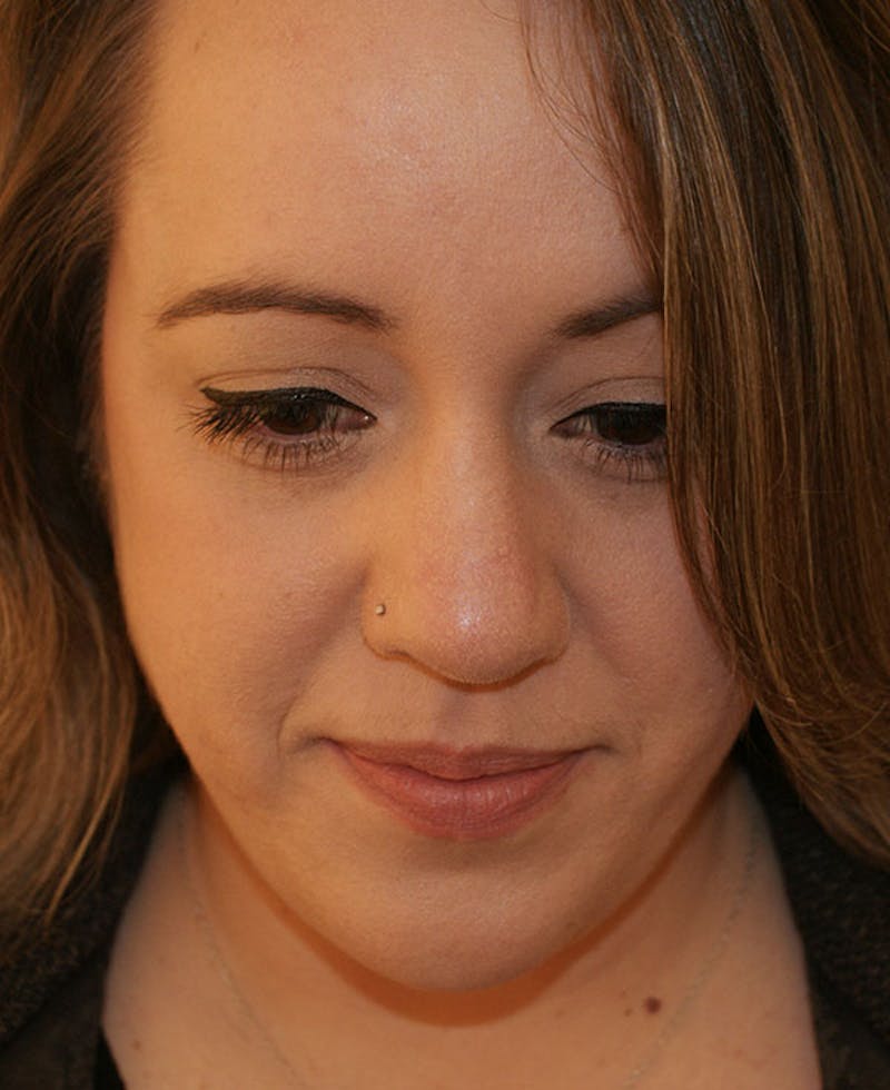 Rhinoplasty Before & After Gallery - Patient 145615 - Image 10