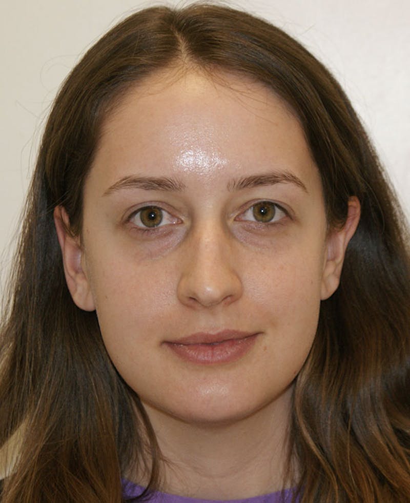 Rhinoplasty Before & After Gallery - Patient 361218 - Image 5