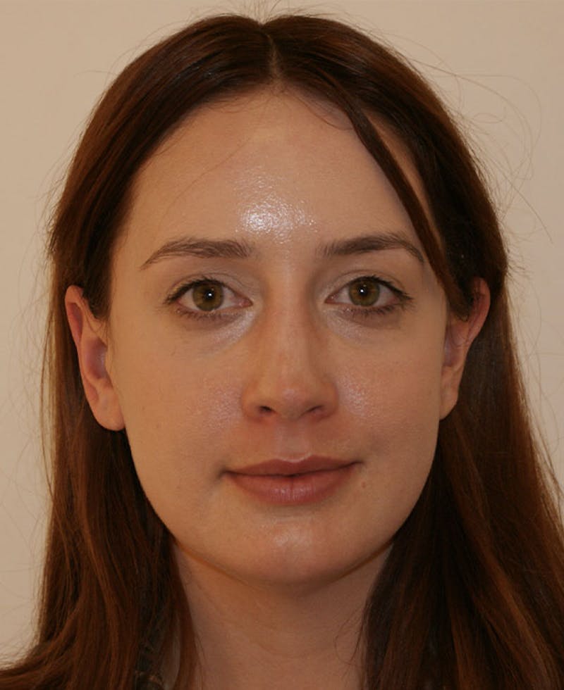 Rhinoplasty Before & After Gallery - Patient 361218 - Image 6