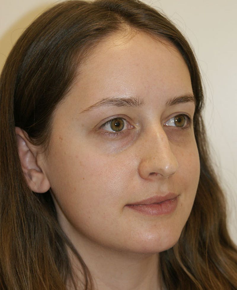 Rhinoplasty Before & After Gallery - Patient 361218 - Image 3