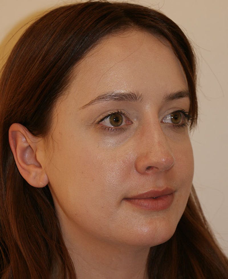 Rhinoplasty Before & After Gallery - Patient 361218 - Image 4
