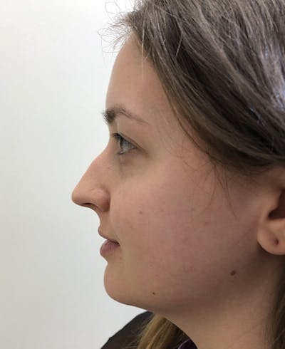 Rhinoplasty Before & After Gallery - Patient 361218 - Image 1