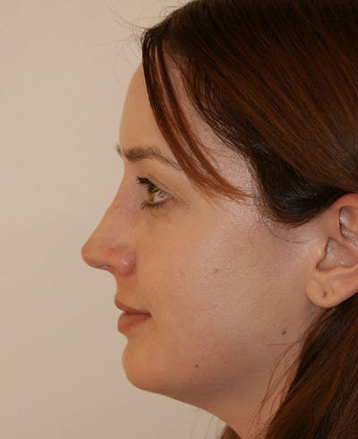 Rhinoplasty Before & After Gallery - Patient 361218 - Image 2