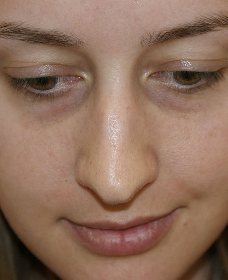 Rhinoplasty Before & After Gallery - Patient 361218 - Image 7