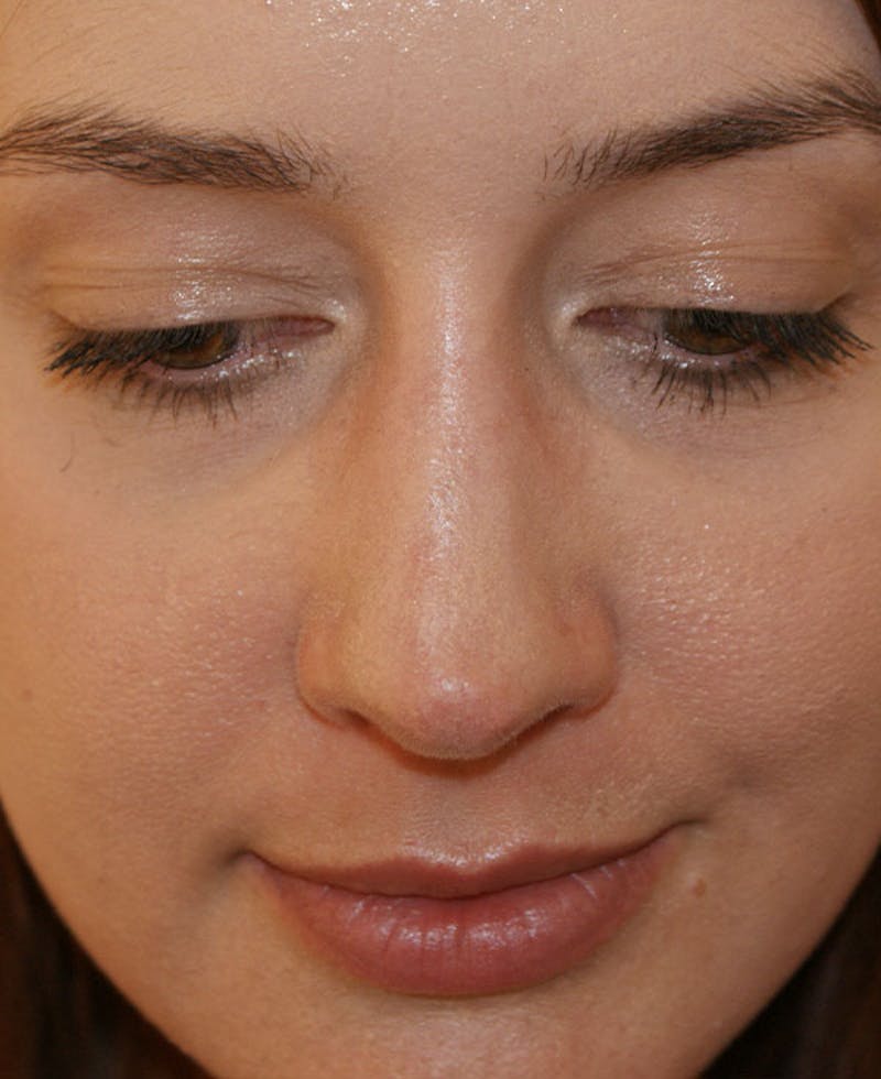 Rhinoplasty Before & After Gallery - Patient 361218 - Image 8