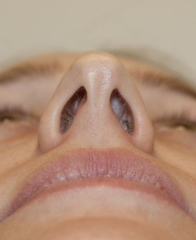 Rhinoplasty Before & After Gallery - Patient 361218 - Image 9