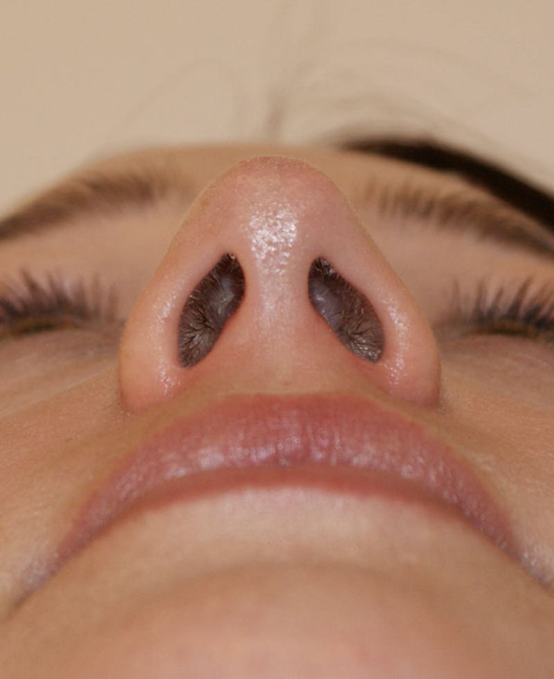 Rhinoplasty Before & After Gallery - Patient 361218 - Image 10