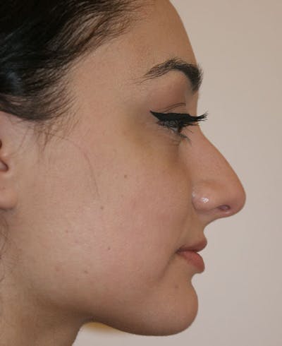 Rhinoplasty Before & After Gallery - Patient 333019 - Image 1