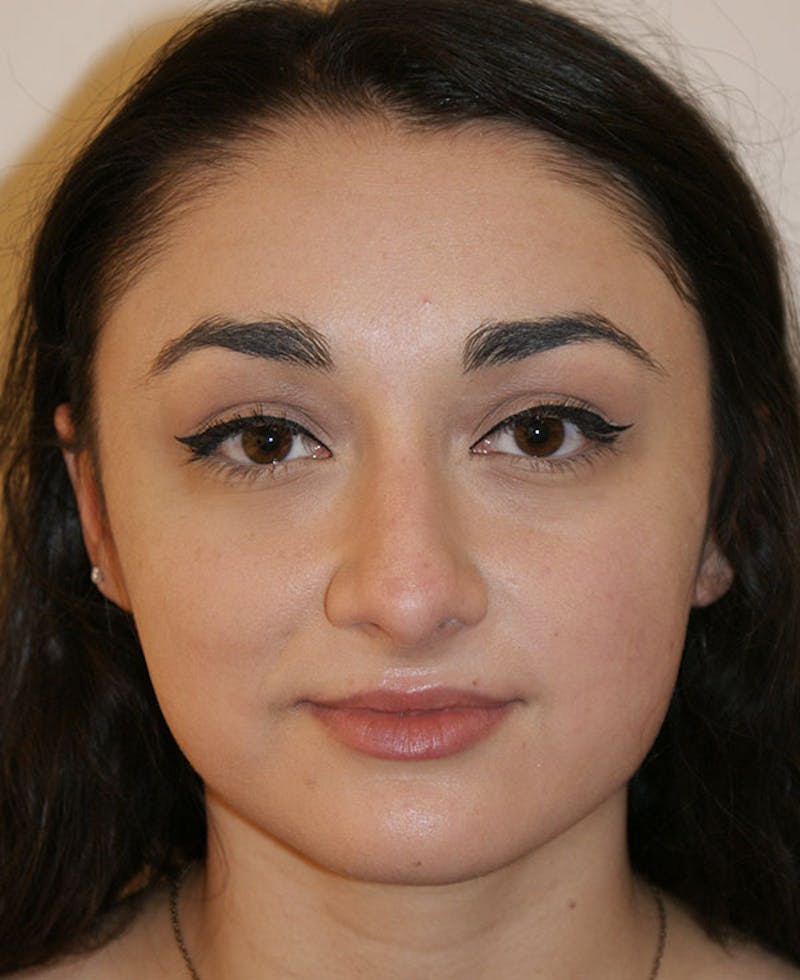 Rhinoplasty Before & After Gallery - Patient 333019 - Image 5