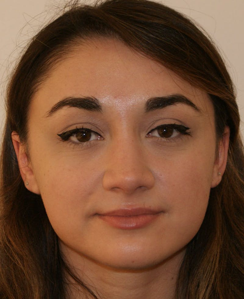 Rhinoplasty Before & After Gallery - Patient 333019 - Image 6