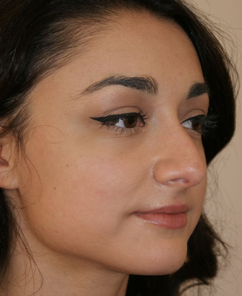Rhinoplasty Before & After Gallery - Patient 333019 - Image 3