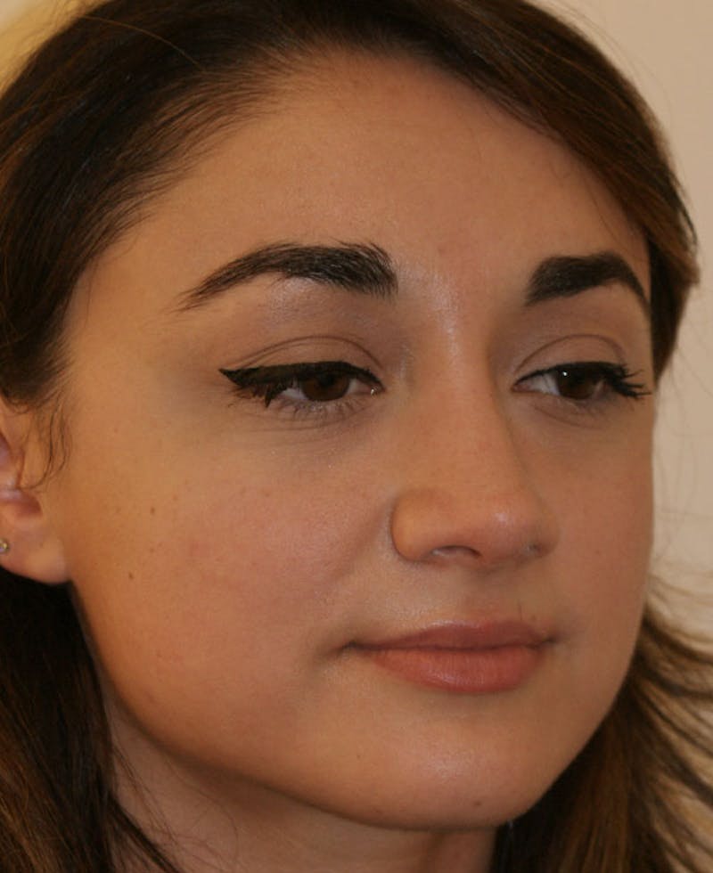Rhinoplasty Before & After Gallery - Patient 333019 - Image 4