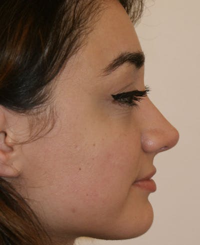 Rhinoplasty Before & After Gallery - Patient 333019 - Image 2