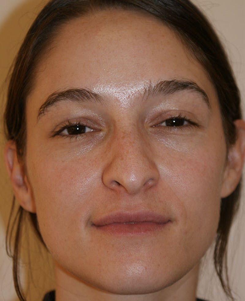 Rhinoplasty Before & After Gallery - Patient 286059 - Image 5