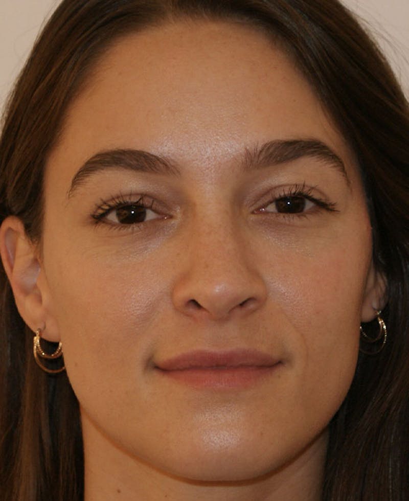 Rhinoplasty Before & After Gallery - Patient 286059 - Image 6
