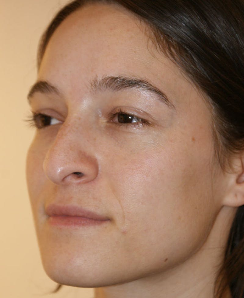 Rhinoplasty Before & After Gallery - Patient 286059 - Image 3