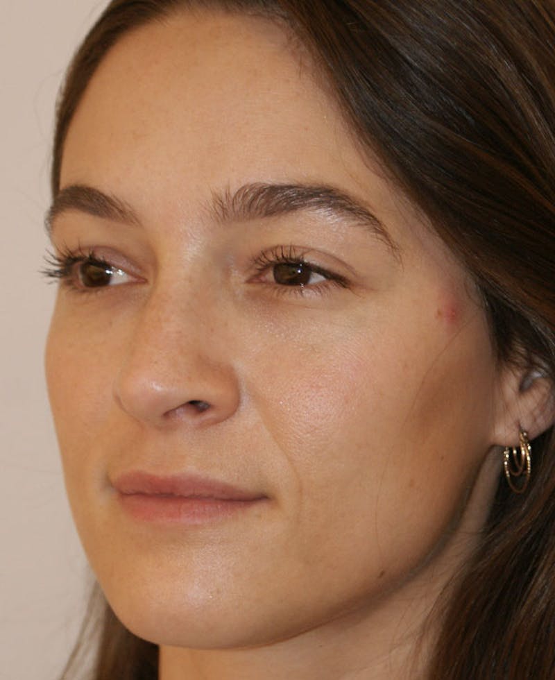 Rhinoplasty Before & After Gallery - Patient 286059 - Image 4