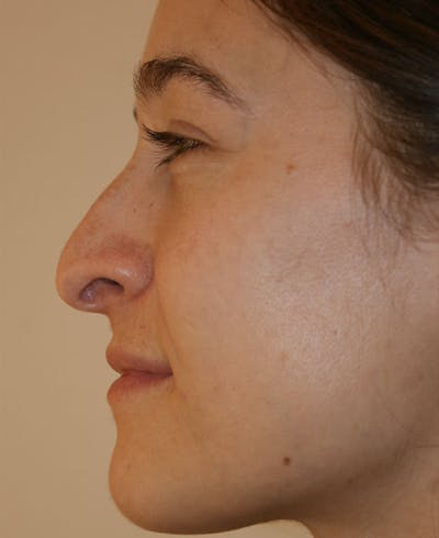 Rhinoplasty Before & After Gallery - Patient 286059 - Image 1