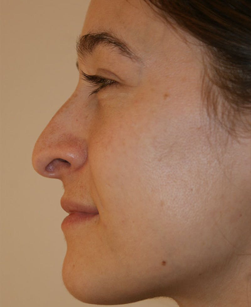 Rhinoplasty Before & After Gallery - Patient 286059 - Image 1