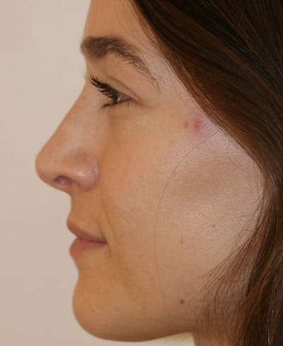 Rhinoplasty Before & After Gallery - Patient 286059 - Image 2