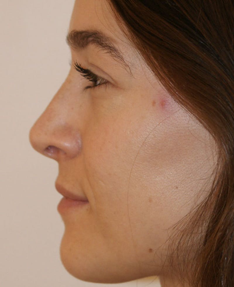 Rhinoplasty Before & After Gallery - Patient 286059 - Image 2