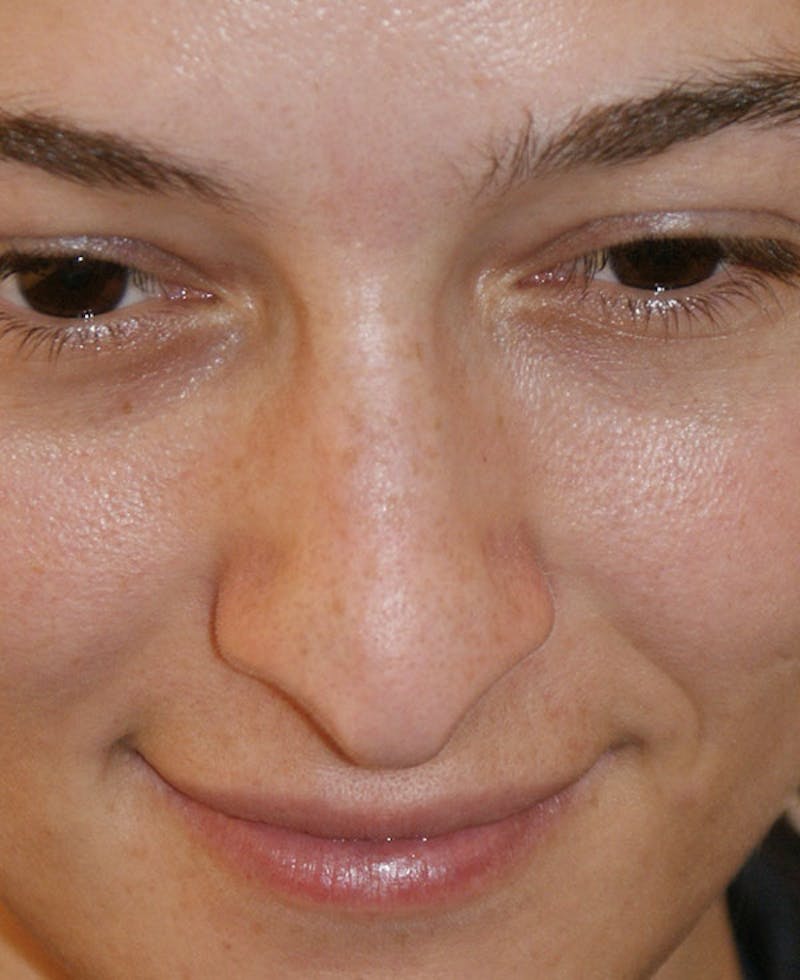 Rhinoplasty Before & After Gallery - Patient 286059 - Image 7