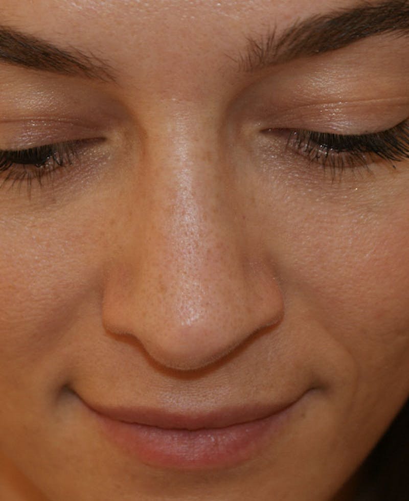 Rhinoplasty Before & After Gallery - Patient 286059 - Image 8