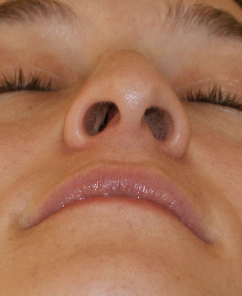 Rhinoplasty Before & After Gallery - Patient 286059 - Image 9