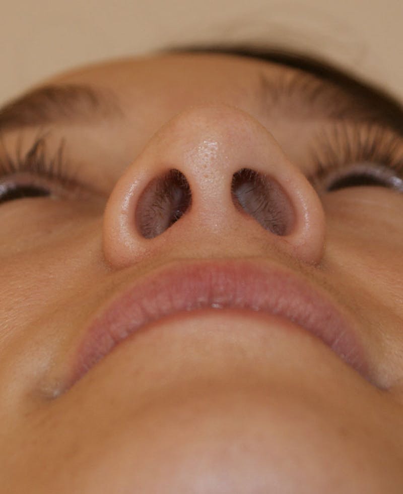 Rhinoplasty Before & After Gallery - Patient 286059 - Image 10