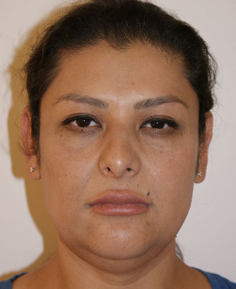 Rhinoplasty Before & After Gallery - Patient 171371 - Image 5