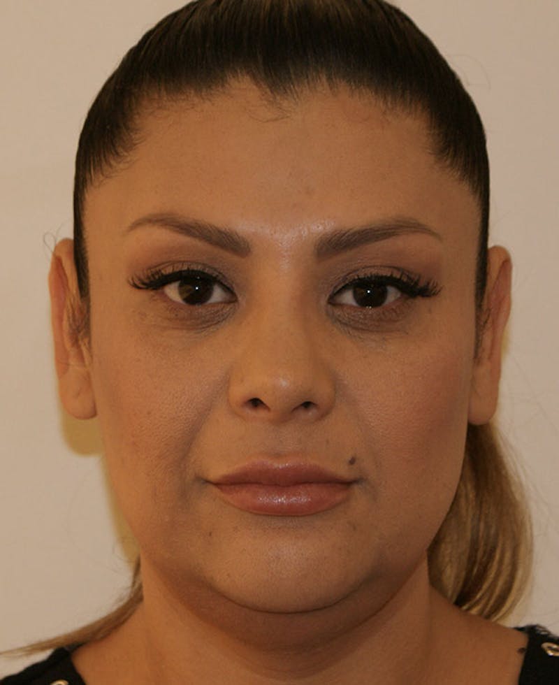 Rhinoplasty Before & After Gallery - Patient 171371 - Image 6