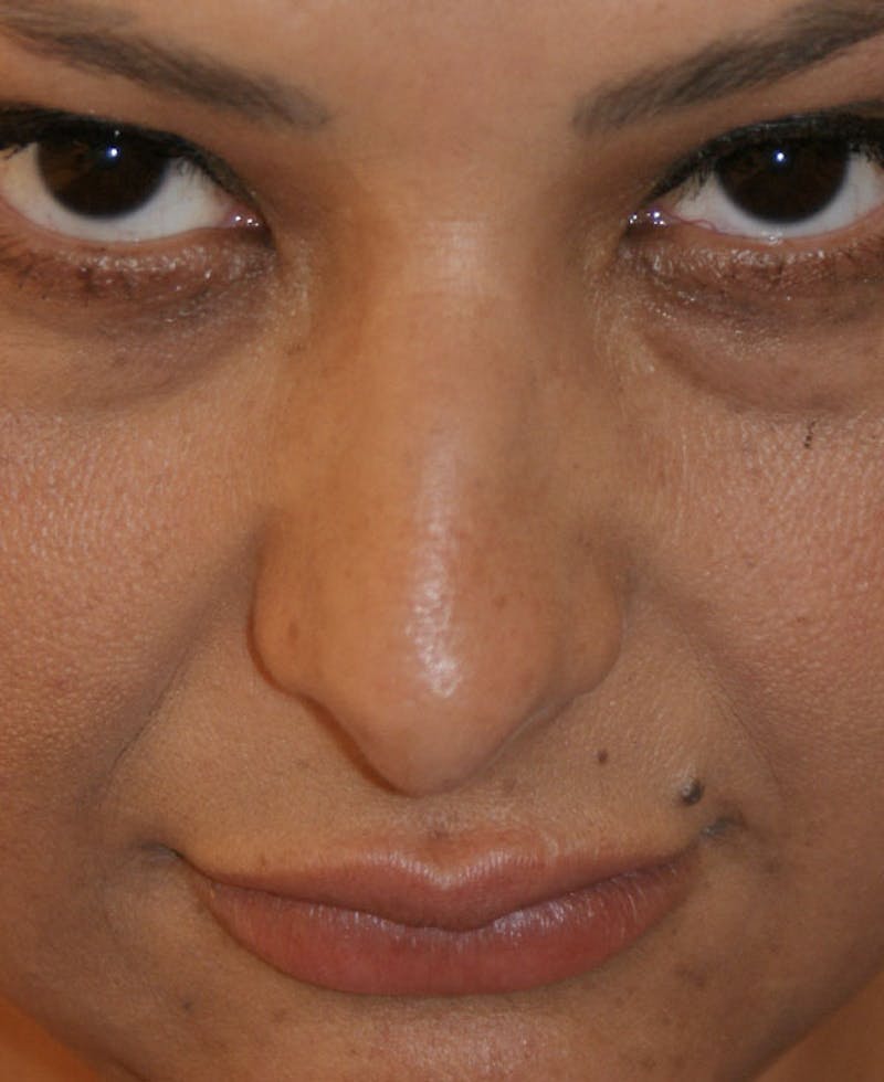 Rhinoplasty Before & After Gallery - Patient 171371 - Image 7