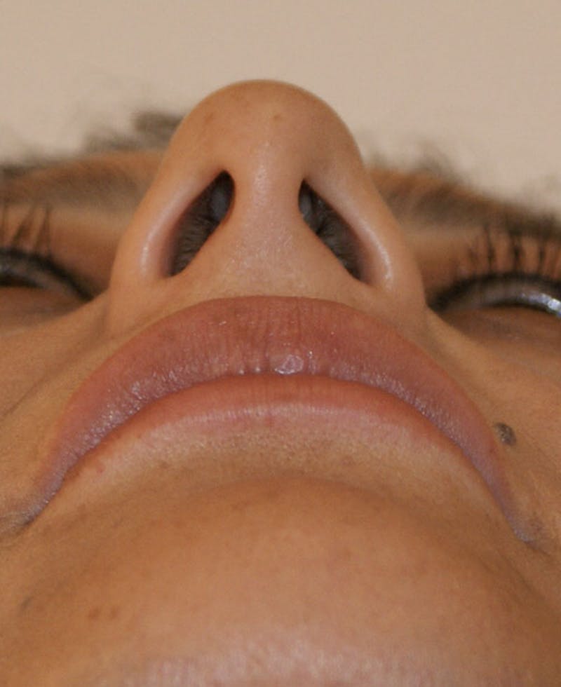 Rhinoplasty Before & After Gallery - Patient 171371 - Image 9