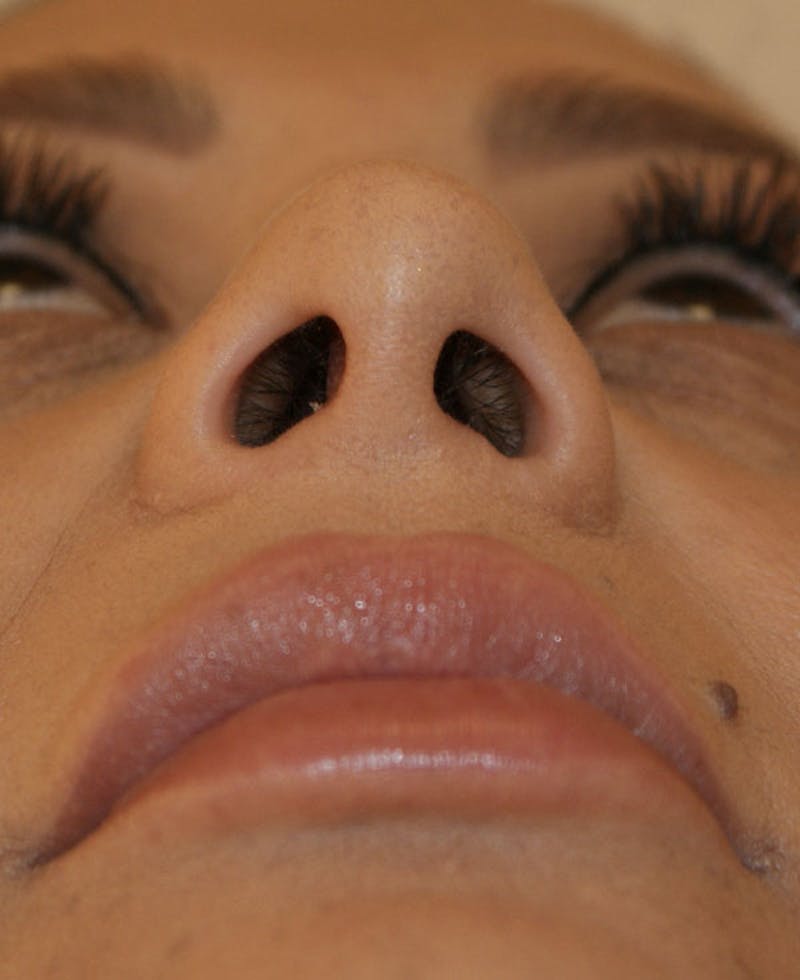 Rhinoplasty Before & After Gallery - Patient 171371 - Image 10