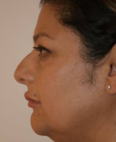 Rhinoplasty Before & After Gallery - Patient 171371 - Image 1