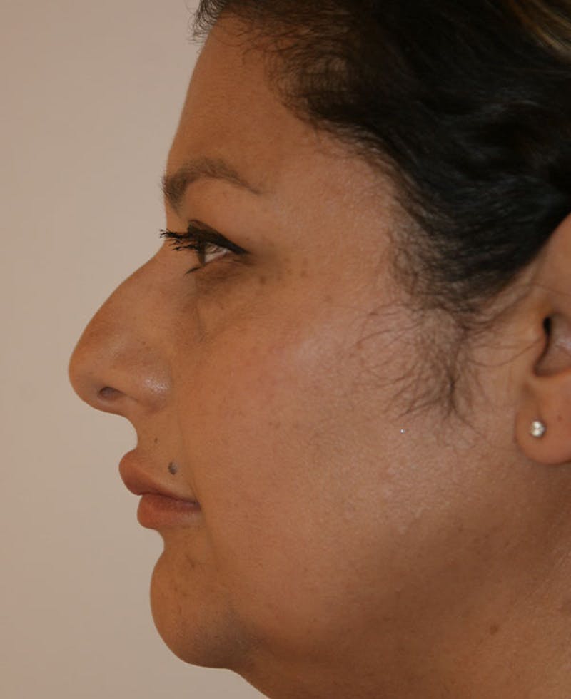 Rhinoplasty Before & After Gallery - Patient 171371 - Image 1